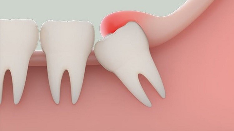 dấu hiệu mọc răng khôn