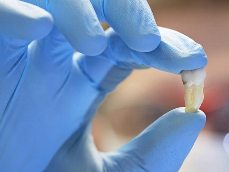 địa chỉ nhổ răng khôn uy tín tại Hải Phòng