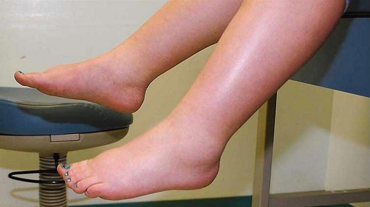 nguyên nhân chủ yếu gây ra phù nề khi mang thai