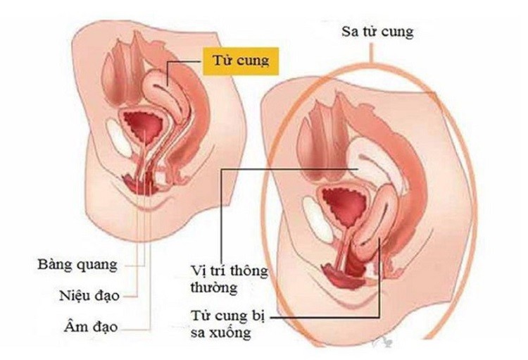 dấu hiệu sa tử cung sau sinh, tiền sản giật tháng cuối, tiền sản giật khi mang thai, dấu hiệu sa tử cung khi mang thai, dấu hiệu tiền sản giật ở bà bầu, dấu hiệu sa tử cung sau sinh mổ, nguy cơ tiền sản giật ở bà bầu, tiền sản giật thai kỳ, bệnh tiền sản giật ở phụ nữ mang thai, dấu hiệu sa tử cung nhẹ, triệu chứng tiền sản giật ở bà bầu, tiền sản giật ở phụ nữ mang thai, dấu hiệu sa tử cung cấp độ 1, dấu hiệu xà tử cung, bệnh tiền sản giật ở bà bầu, hiện tượng tiền sản giật ở bà bầu, tiền sản giật ở thai phụ, tiền sản giật trong thai kỳ, thai phụ bị tiền sản giật, mẹ bầu bị tiền sản giật, bà bầu bị tiền sản giật, triệu chứng tiền sản giật ở thai phụ, dấu hiệu sa tử cung, dấu hiệu sa tử cung webtretho, dấu hiệu bị sa tử cung, dấu hiệu của sa tử cung, các dấu hiệu sa tử cung, những dấu hiệu sa tử cung, nguyên nhân và dấu hiệu sa tử cung, tiền sản giật ở bà bầu la gi, chứng tiền sản giật ở bà bầu, biểu hiện của tiền sản giật ở bà bầu, tiền sản giật ở bà bầu là gì