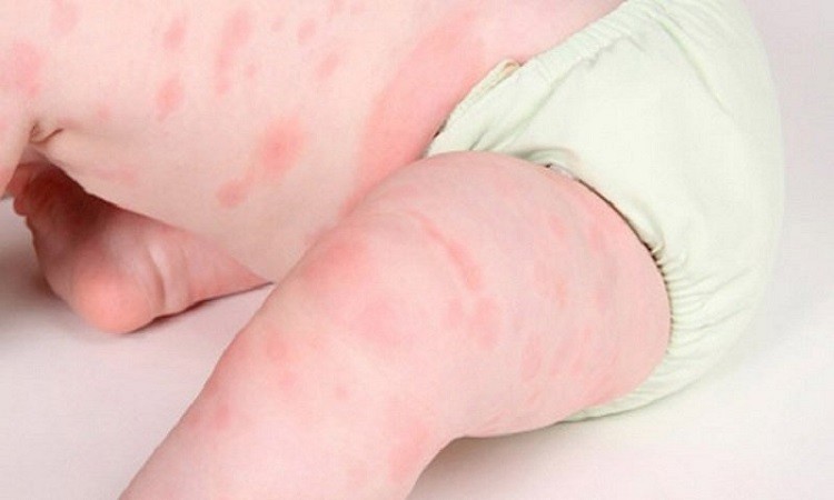 Bệnh ngoài da ở trẻ em bệnh ngoài da ở trẻ em, bệnh ngoài da ở trẻ, bệnh ngoài da ở chân, bệnh ngoài da ở lưng, bệnh ngoài da ở tay, các bệnh ngoài da ở trẻ em, bệnh ngoài da ở trẻ sơ sinh