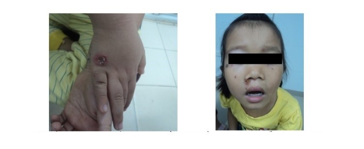 bệnh chốc lở ở trẻ em, chốc lở ở trẻ em, bệnh chốc loét ở trẻ em, bệnh chốc ở trẻ, bệnh chốc lở đầu ở trẻ em, bệnh chốc đầu ở trẻ em, cách điều trị bệnh chốc lở ở trẻ em, bệnh chốc mép ở trẻ em, bệnh chốc da ở trẻ em, bệnh chốc ở trẻ nhỏ, bệnh chốc lở ở trẻ nhỏ, điều trị bệnh chốc lở ở trẻ em, viêm da chốc lở trẻ em, bệnh chốc trẻ em, cách trị bệnh chốc lở ở trẻ em, bệnh chốc ở trẻ em có nguy hiểm không